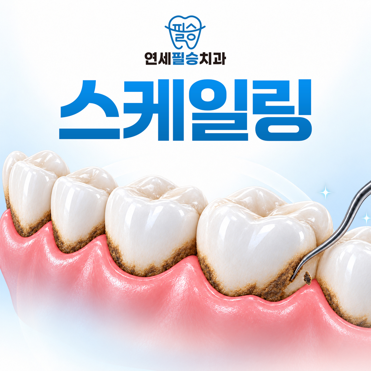 연세필승치과 스케일링
