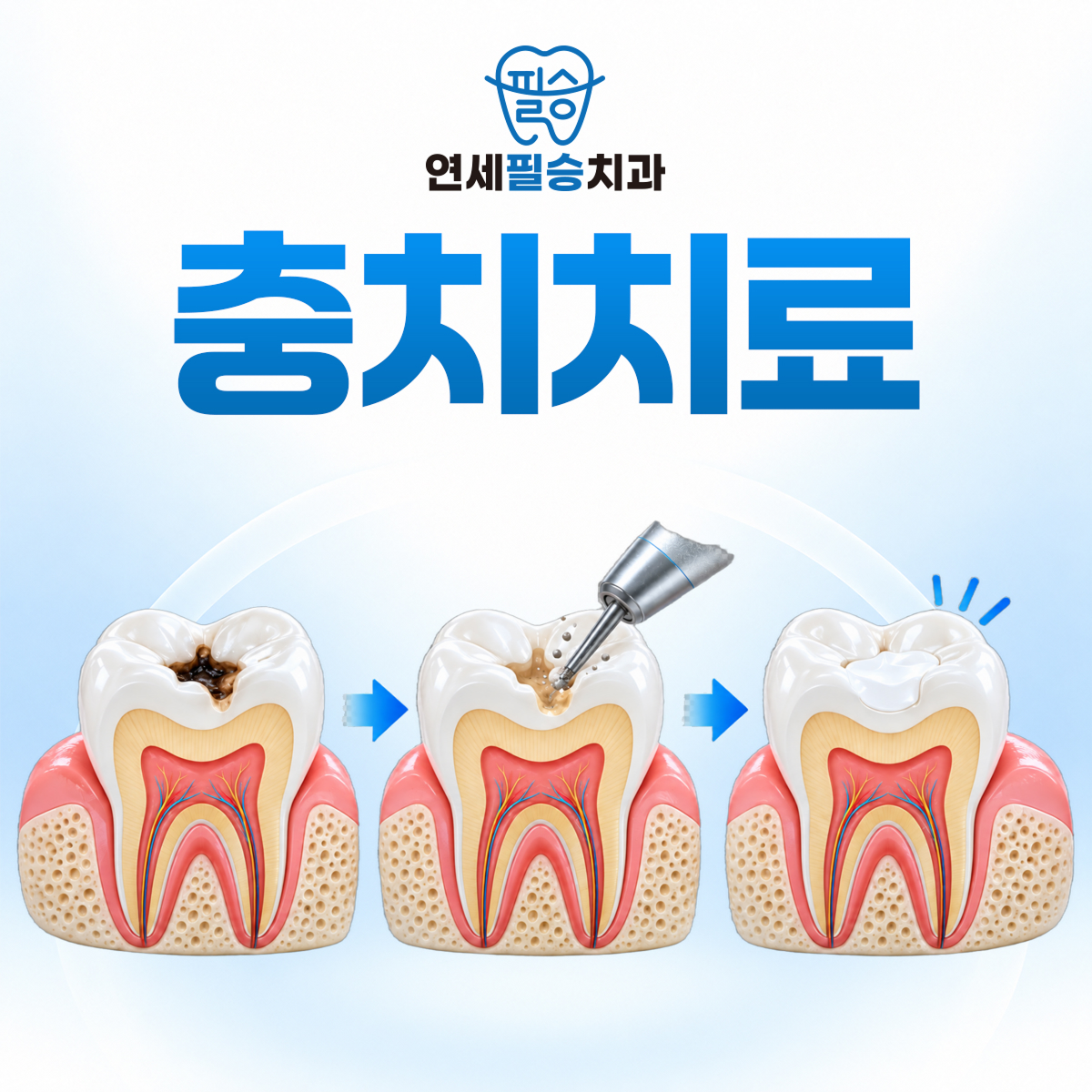 연세필승치과 충치치료